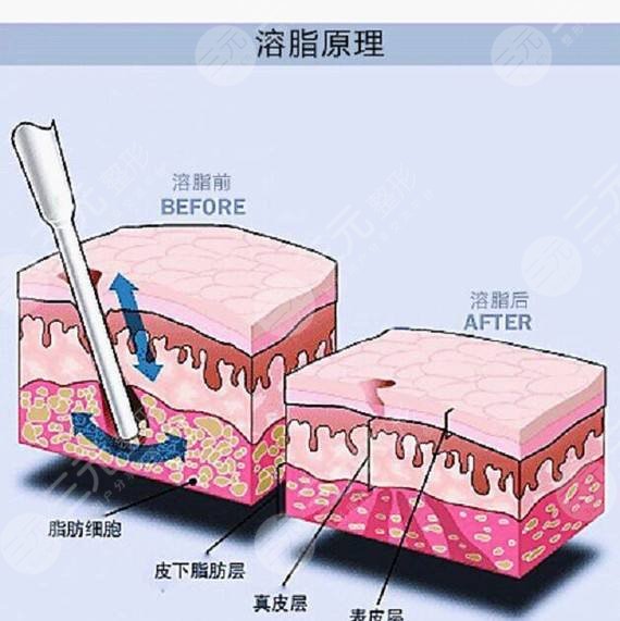 瘦腿,溶脂,激光