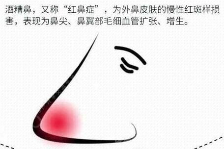 酒糟鼻