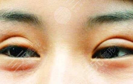睁眼费力