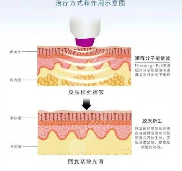 激光治抬头纹