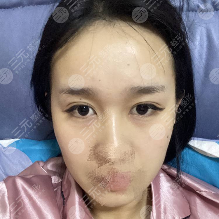 健丽医美去眼袋费用很贵吗?看完你会觉得很值!