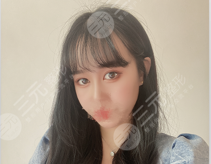 健丽医美去眼袋费用很贵吗?看完你会觉得很值!