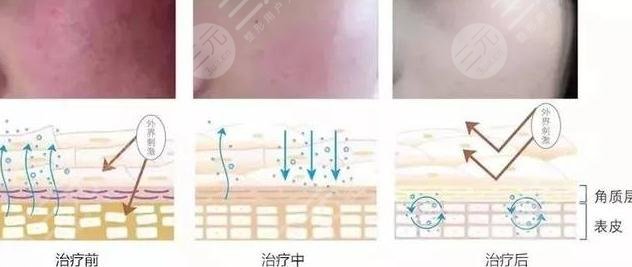 激光去红血丝