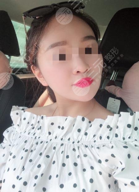 去红血丝术后