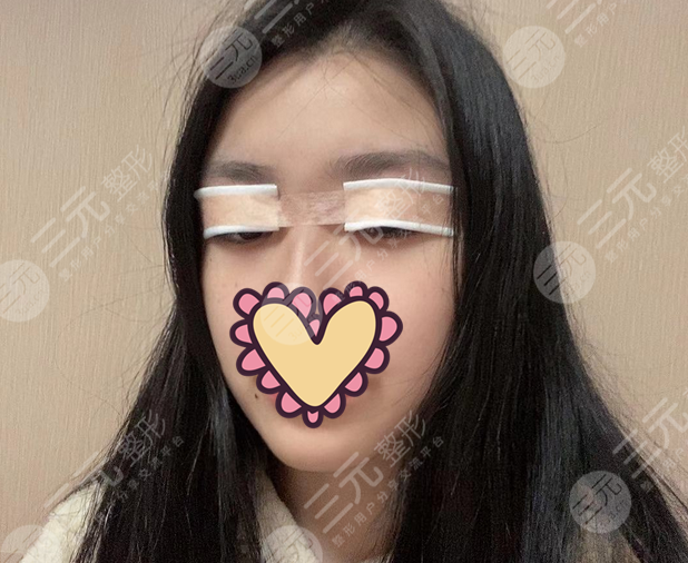 双眼皮手术后