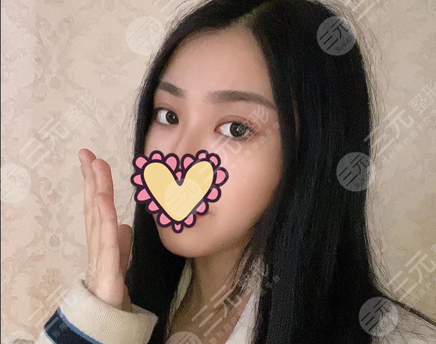 双眼皮术后15天