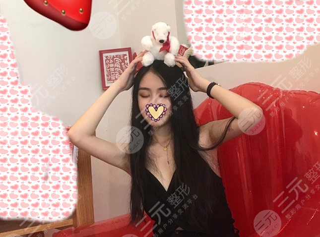 双眼皮术后45天