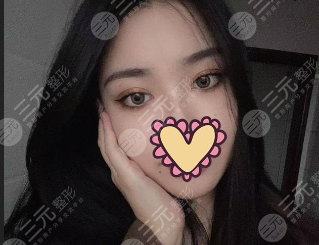 双眼皮术后70天