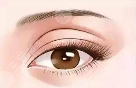 做上睑下垂手术要多少钱费用恢复期注意事项超全分享