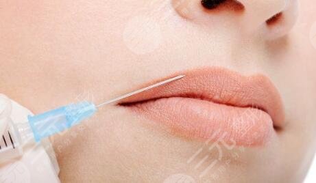 胶原蛋白丰唇后注意事项