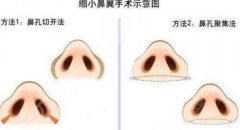 大鼻翼整形要多少钱？价格分享，精致美鼻这样来！