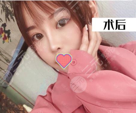 鼻翼缩小术后三个月