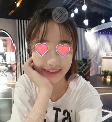 玻尿酸隆鼻术后两周