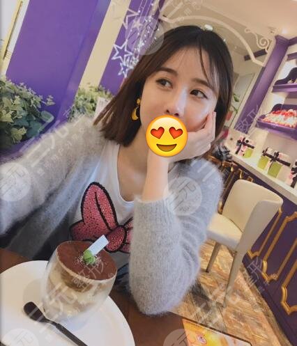 玻尿酸隆鼻术后三个月