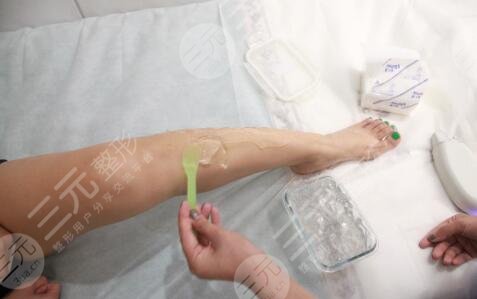 激光脱毛的价格