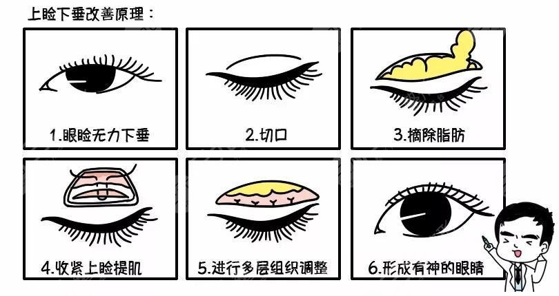 先天性眼睑下垂手术