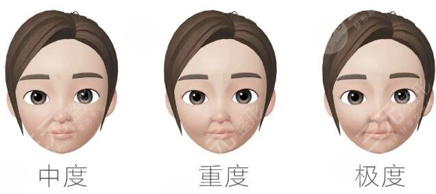 填充法令纹用什么方法好？分享科普，减龄超明X！