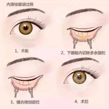 眼袋切除手术