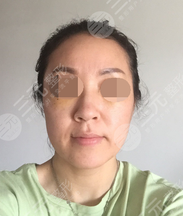 面部年轻化plus全脸，快速解决面部问题，内附真实案例分享图