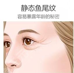 怎样才能去鱼尾纹?轻医美有效方法科普!笑容更魅力!