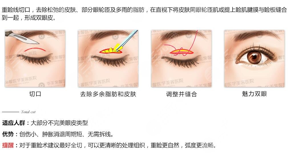 微创双眼皮需要多少钱