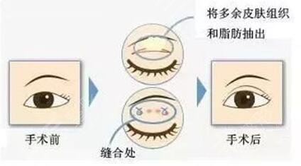 眼部抽脂减肥