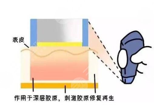 激光嫩肤