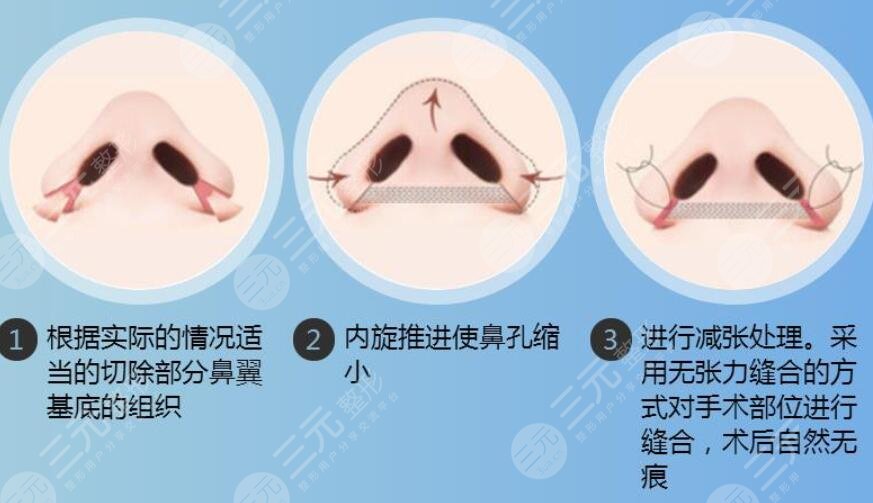 鼻孔缩小手术果明X吗