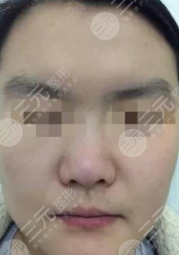 北海市人民医院去太田痣案例