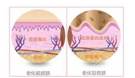 生物术除皱果能维持多久