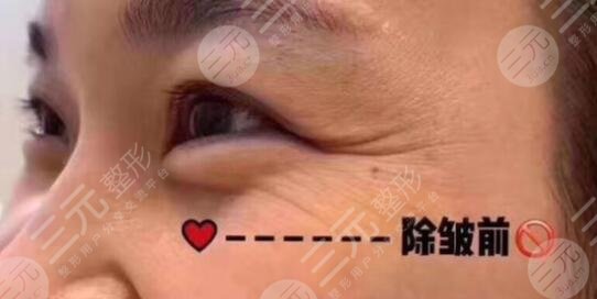 生物除皱术前