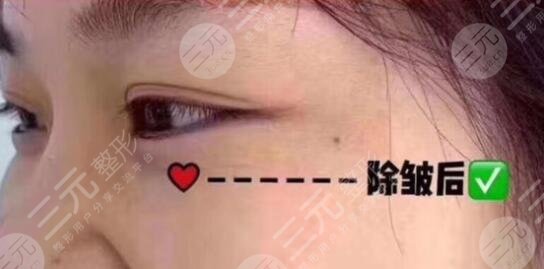 生物除皱术后