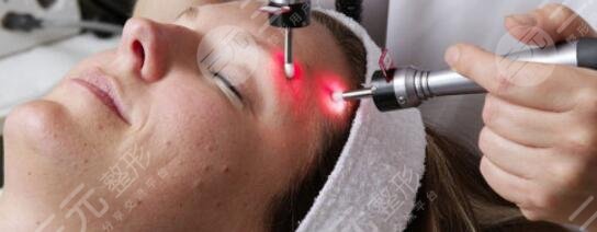 像素激光治疗痘疤果怎么样手术价格是多少