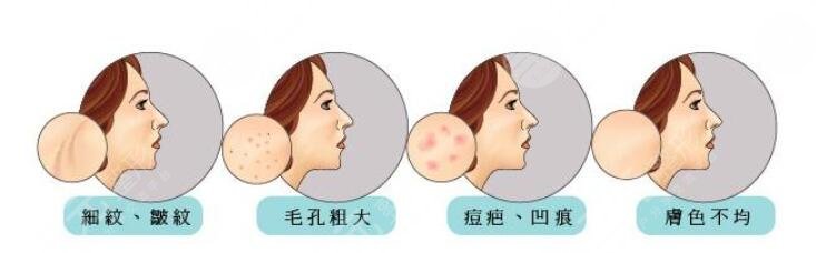 像素激光缓解痘疤的价格