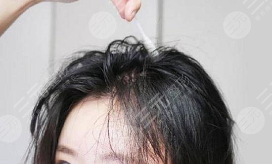 植发可以维持多久呢?植发的费用,带你详细做个了解 植发可以维持多久呢?植发的费用,带你详细做个了解