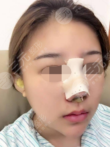 湘雅医院医美整形科鼻子矫正后