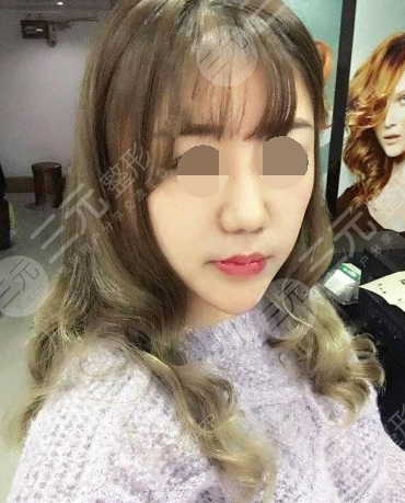 湘雅医院医美整形科鼻子矫正后2个月
