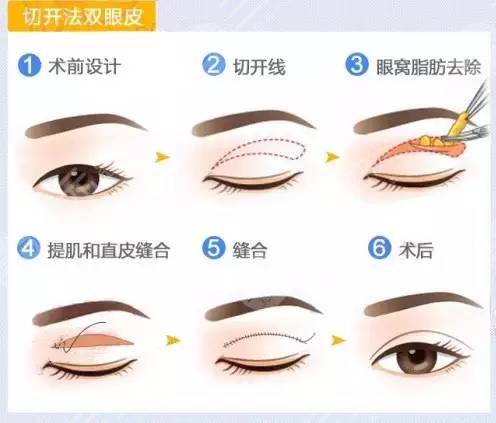 开眼角9mm平行双眼皮，双眼皮术前术后的注意事项大公开！