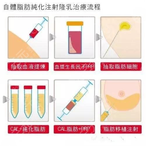 自体脂肪丰胸的风险有哪些