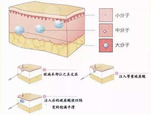 玻尿酸淡化法令纹