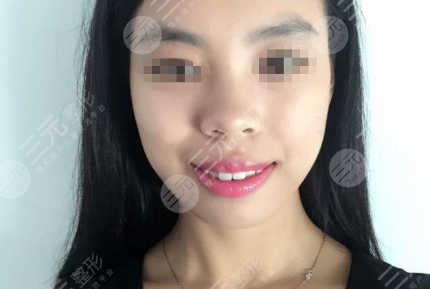 荆门雅泰口腔半隐形陶瓷矫正分享