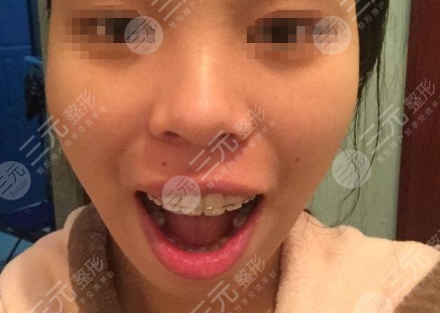 荆门雅泰口腔半隐形陶瓷矫正分享