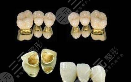 烤瓷牙的价格