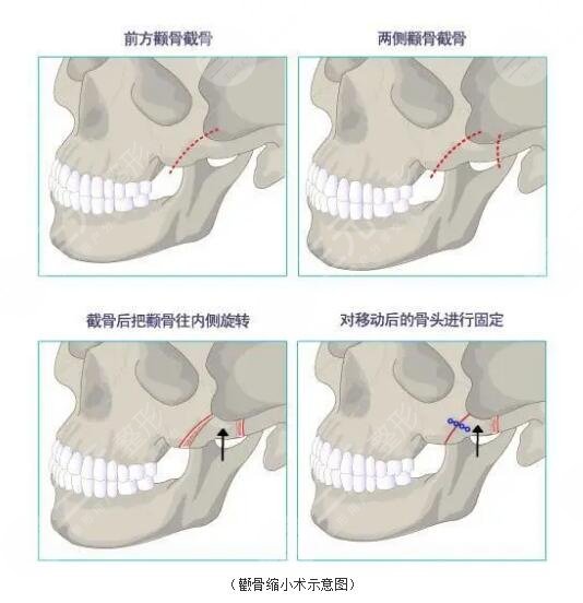 下颌角整形术有危险吗？下颌角整形术的适宜人群有哪些？