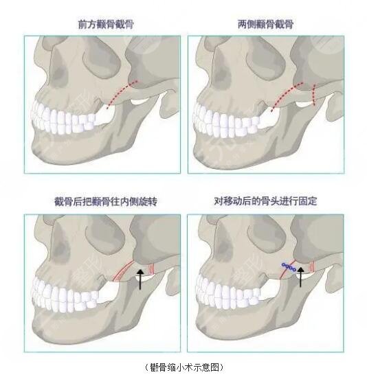 下颌角整形术有危险吗?下颌角整形术的适宜人群有哪些?
