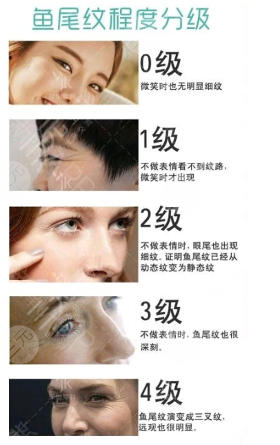 鱼尾纹怎么去除