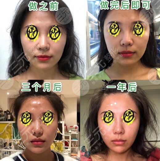 热玛吉前后对比果图,爱美人士都会震惊热玛吉的果是多么神奇和率高