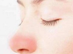 鼻子两侧有红血丝怎么办？是什么原因造成的？