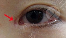 开眼角疤痕增生原因