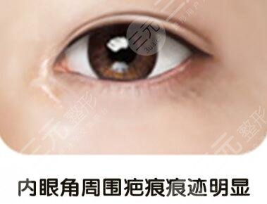 开眼角疤痕增生